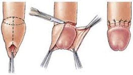 penis 3 Resim2 b